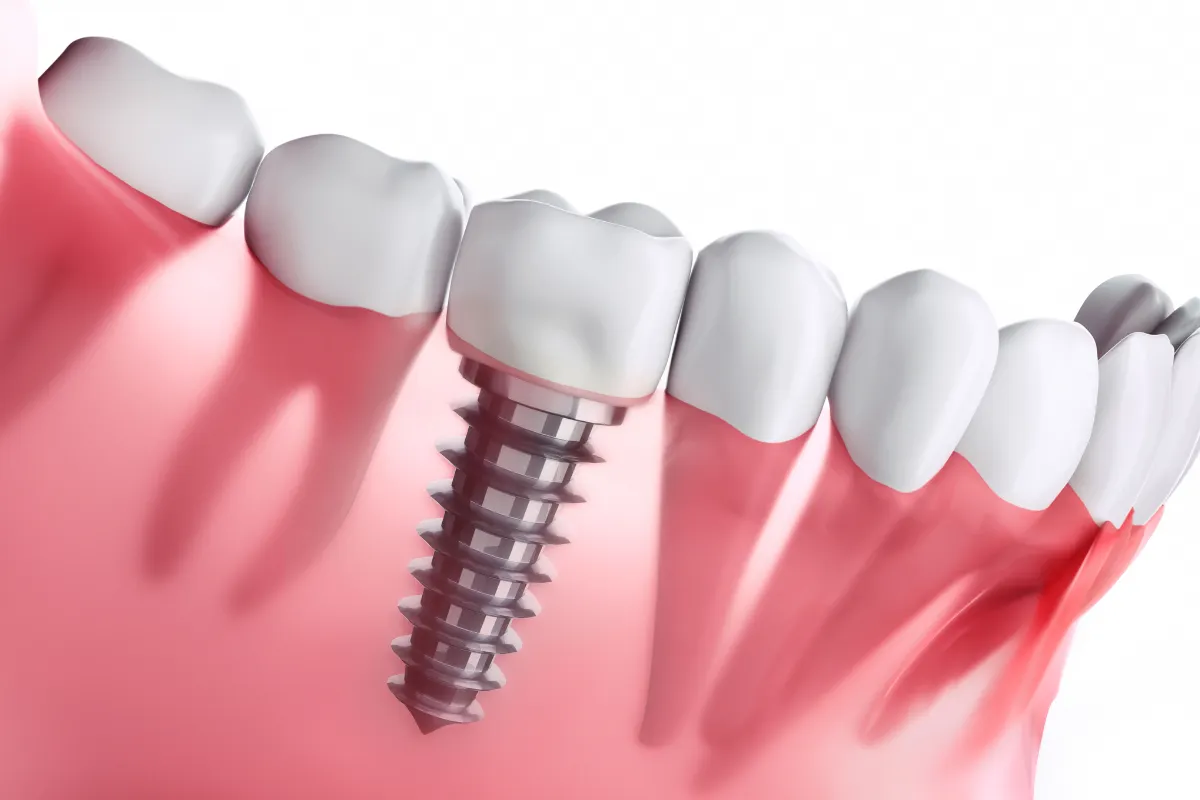 Dental Implant Services