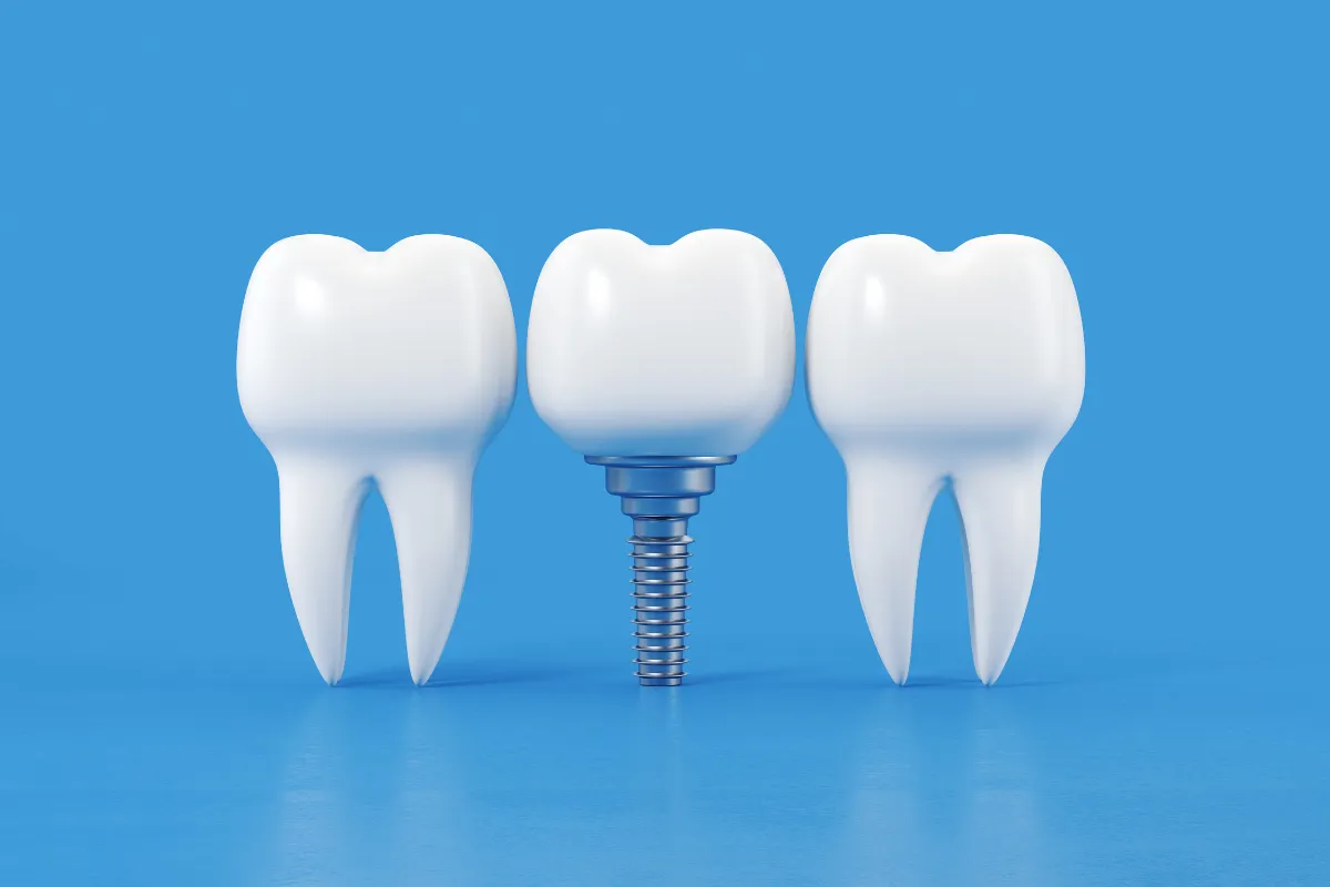 Dental Implant Process