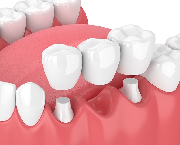 image of a dental bridge