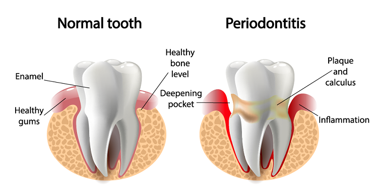 image displays comparison between healthy and inflammed gums