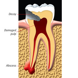 this is an image of root canal treatment