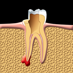 this is an image of root canal treatment