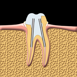 this is an image of root canal treatment